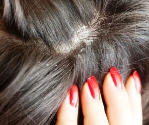 Você sabia que o couro cabeludo – assim como a nossa pele – se descama? Pois bem, isso acontece por conta da renovação de suas células.