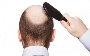 O que é Alopecia? Alopecia é uma infecção caracterizada pela redução parcial ou total dos pelos/cabelos de uma determinada área do corpo.